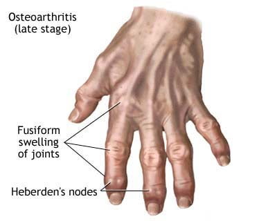 Alarming Sign and Symptoms of Osteoarthritis (OA)