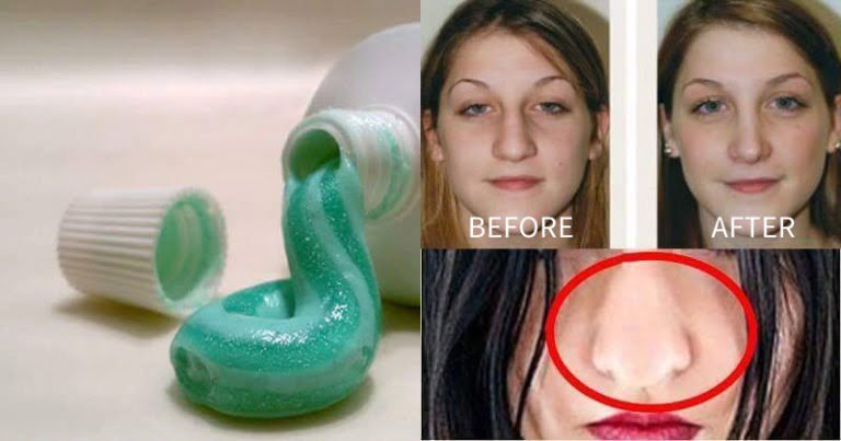 home-remedy-to-make-fat-nose-thinner-naturally-without-surgery